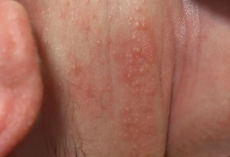 宝宝湿疹的护理方法有哪些？